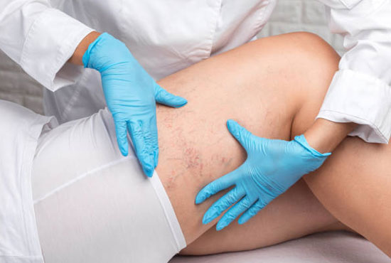 Estetik Damar Tedavileri