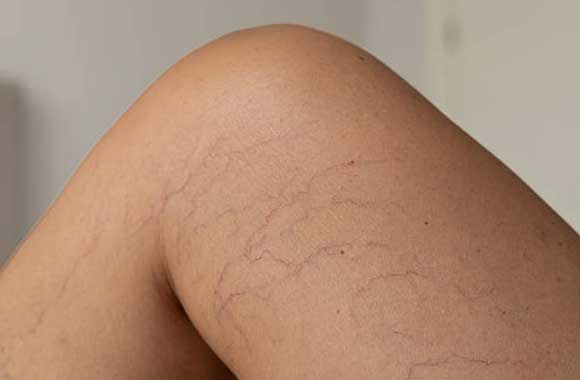 Estetik Varis Tedavisi: CLaCS Yöntemi Nedir?