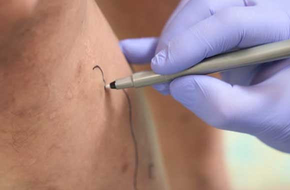 CLaCS Öncesi ve Sonrası Nelere Dikkat Etmeli? İyileşme Süreci ve Sonuçları Korumak