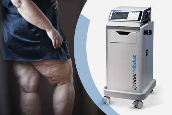 Lipödemde ESWT: Ağrı, Ödem ve Doku Konforunu Destekleyen Şok Dalga Tedavisi